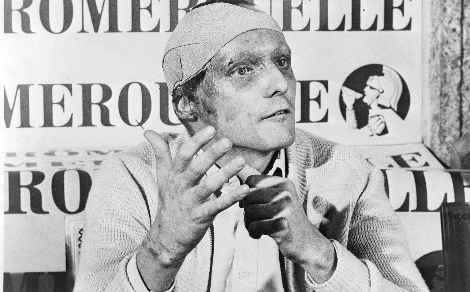 Picture of Niki Lauda after the accident
